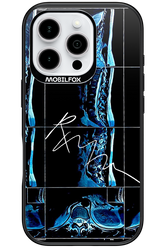 RMN Scolioza - Apple iPhone 16 Pro