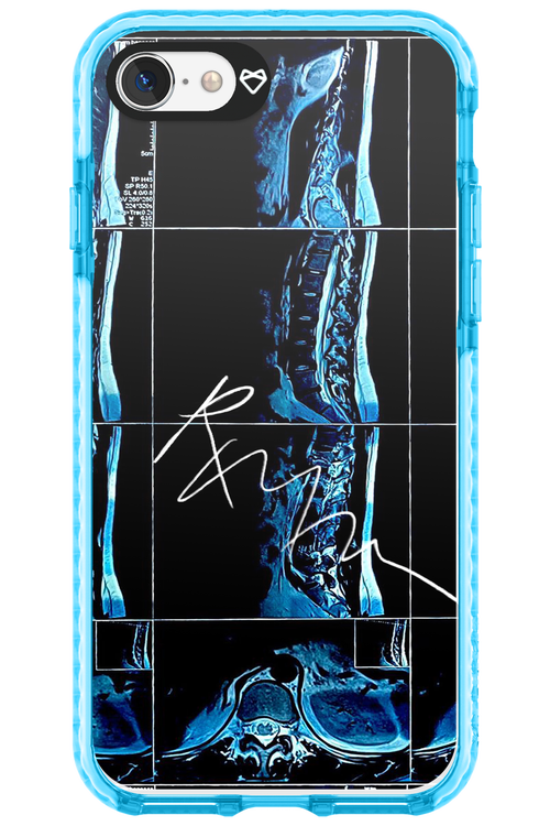 RMN Scolioza 2.0 - Apple iPhone SE 2022