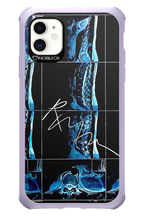 RMN Scolioza 2.0 - Apple iPhone 11