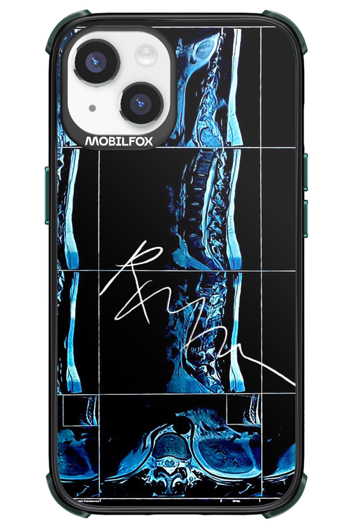 RMN Scolioza 2.0 - Apple iPhone 14