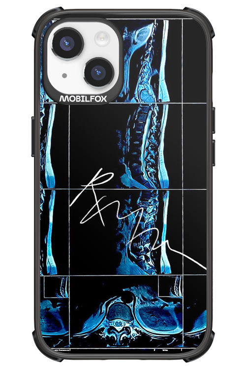 RMN Scolioza 2.0 - Apple iPhone 14