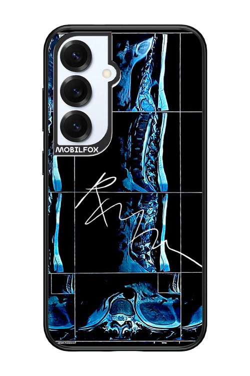RMN Scolioza 2.0 - Samsung S25