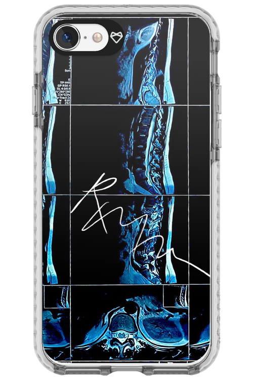 RMN Scolioza 2.0 - Apple iPhone SE 2020