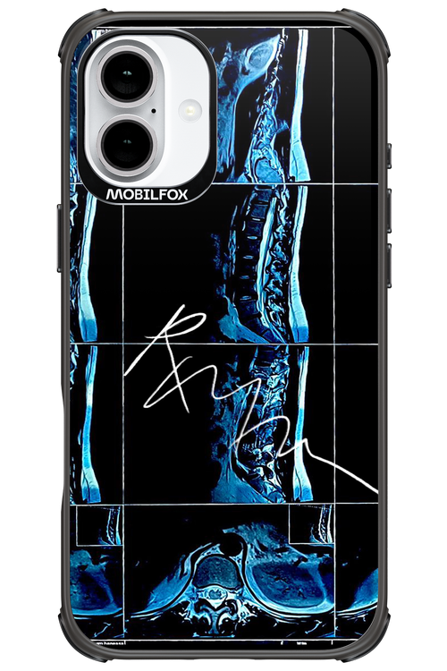RMN Scolioza 2.0 - Apple iPhone 16 Plus