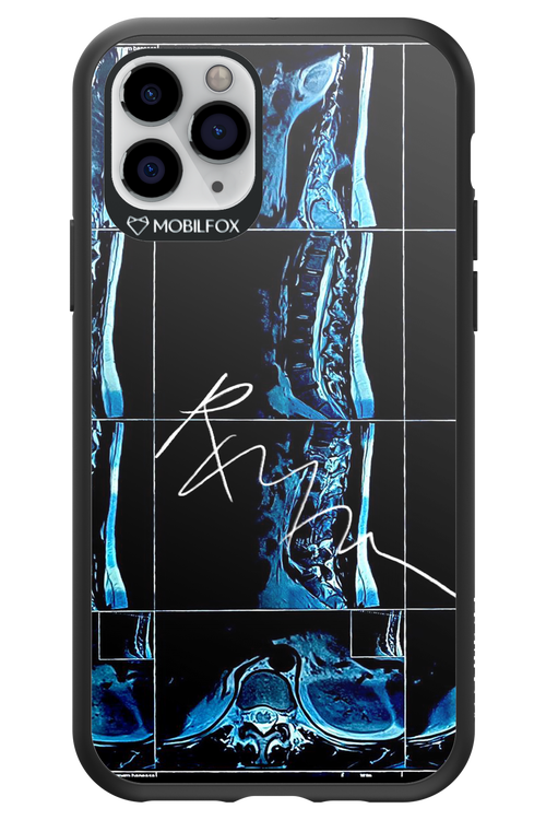 RMN Scolioza 2.0 - Apple iPhone 11 Pro