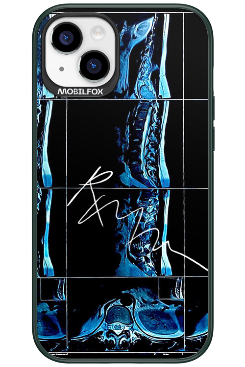 RMN Scolioza 2.0 - Apple iPhone 15 Plus