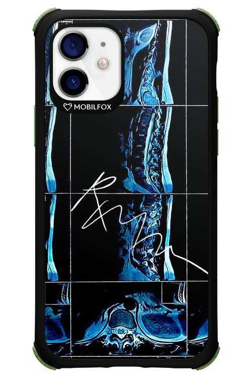 RMN Scolioza 2.0 - Apple iPhone 12