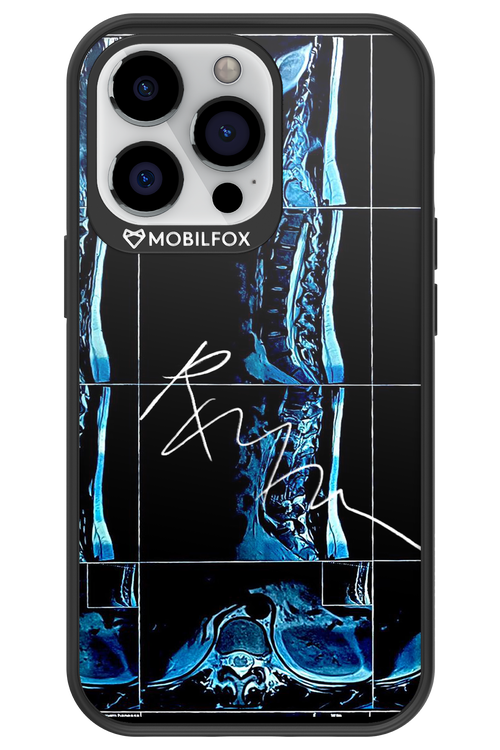RMN Scolioza 2.0 - Apple iPhone 13 Pro