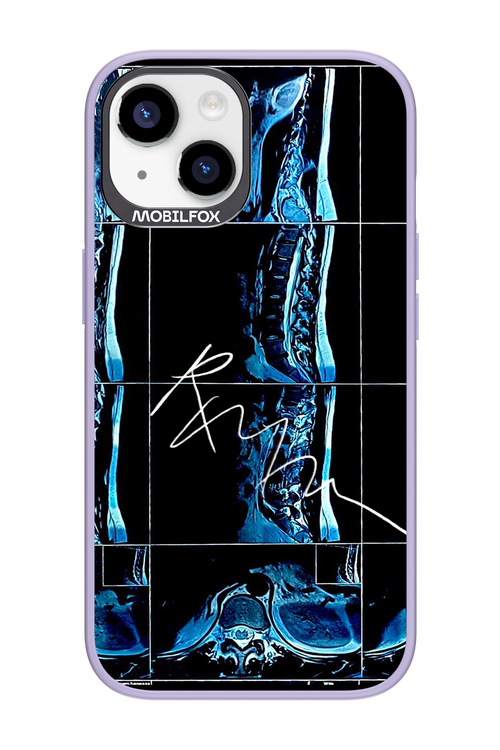 RMN Scolioza 2.0 - Apple iPhone 14