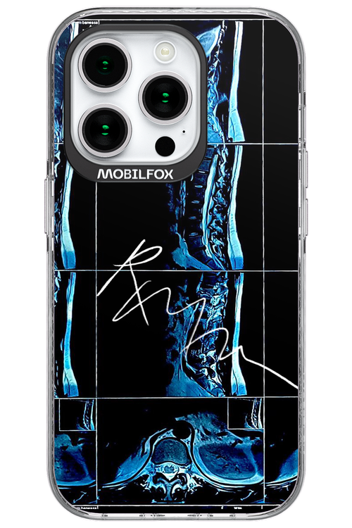 RMN Scolioza 2.0 - Apple iPhone 15 Pro