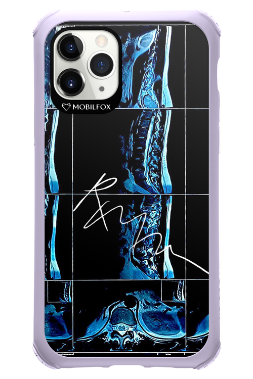 RMN Scolioza 2.0 - Apple iPhone 11 Pro