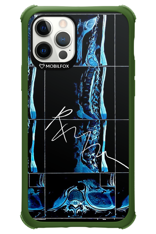 RMN Scolioza 2.0 - Apple iPhone 12 Pro
