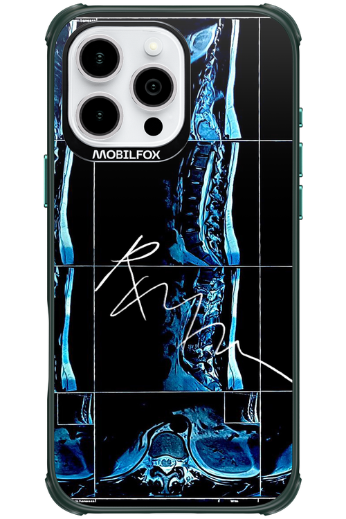 RMN Scolioza 2.0 - Apple iPhone 16 Pro Max
