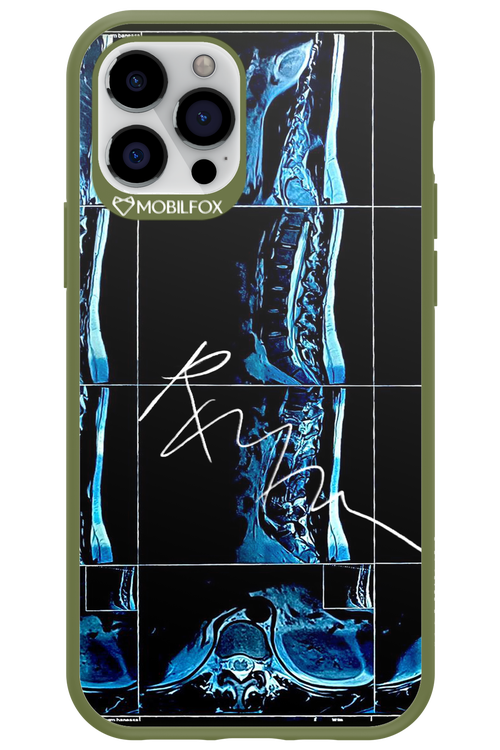 RMN Scolioza 2.0 - Apple iPhone 12 Pro