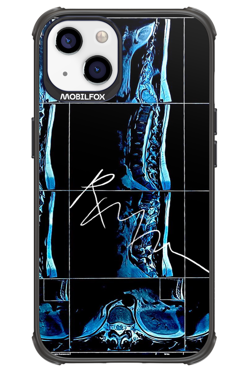 RMN Scolioza 2.0 - Apple iPhone 13