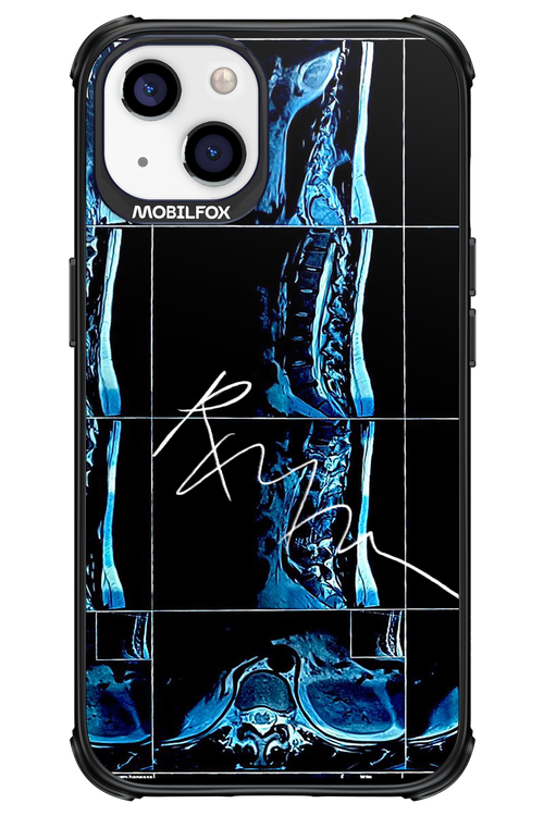 RMN Scolioza 2.0 - Apple iPhone 13