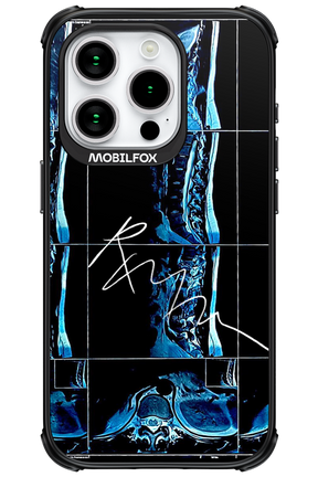 RMN Scolioza - Apple iPhone 15 Pro