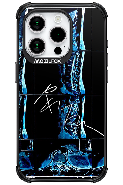 RMN Scolioza - Apple iPhone 15 Pro