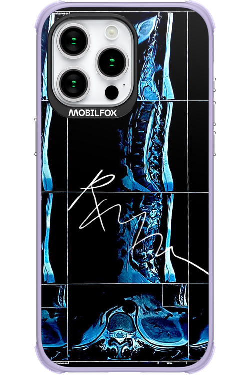 RMN Scolioza - Apple iPhone 15 Pro Max