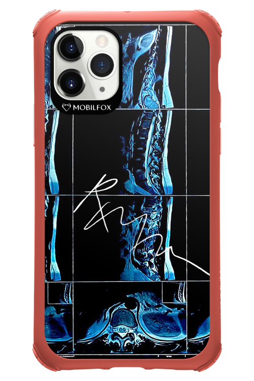 RMN Scolioza 2.0 - Apple iPhone 11 Pro