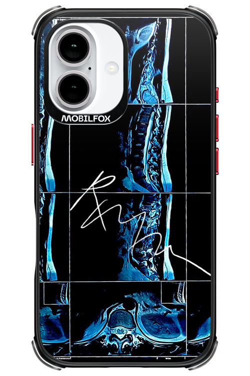 RMN Scolioza 2.0 - Apple iPhone 16