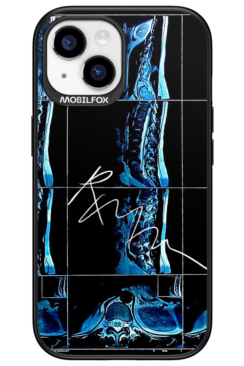 RMN Scolioza 2.0 - Apple iPhone 15