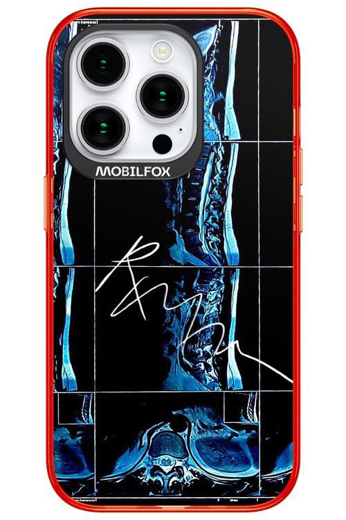 RMN Scolioza 2.0 - Apple iPhone 15 Pro