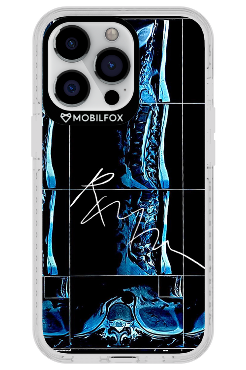 RMN Scolioza 2.0 - Apple iPhone 13 Pro