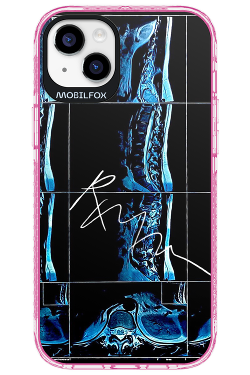 RMN Scolioza 2.0 - Apple iPhone 14 Plus