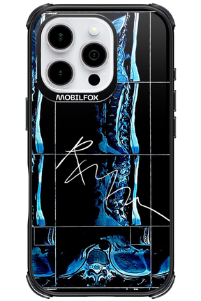 RMN Scolioza - Apple iPhone 16 Pro