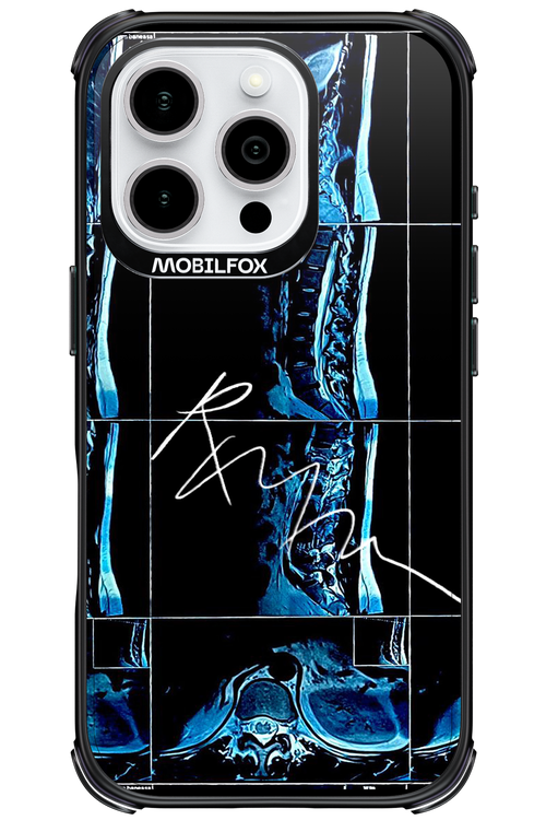 RMN Scolioza - Apple iPhone 16 Pro