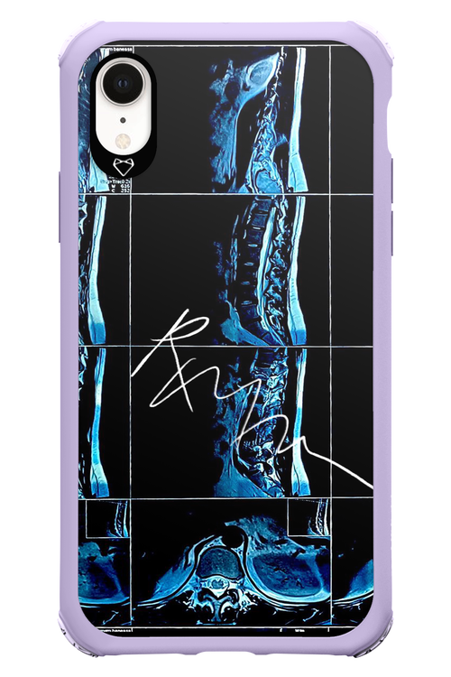 RMN Scolioza 2.0 - Apple iPhone XR