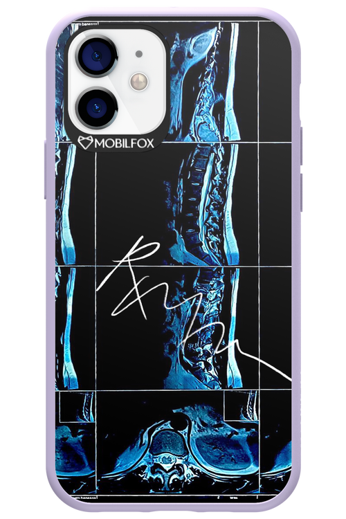 RMN Scolioza 2.0 - Apple iPhone 12