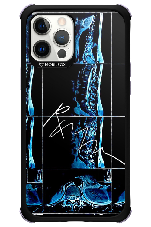 RMN Scolioza 2.0 - Apple iPhone 12 Pro Max