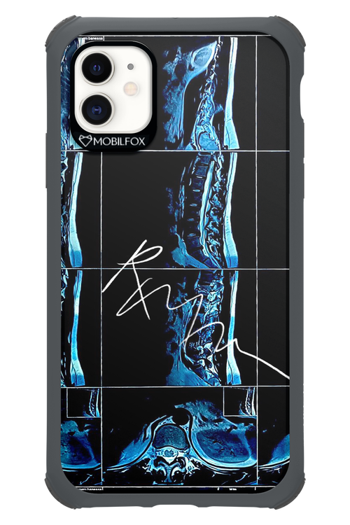 RMN Scolioza 2.0 - Apple iPhone 11