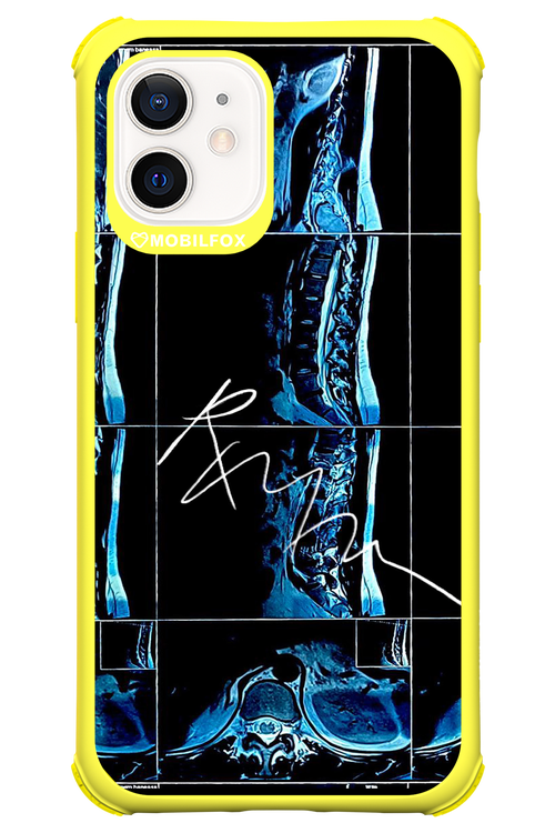 RMN Scolioza 2.0 - Apple iPhone 12