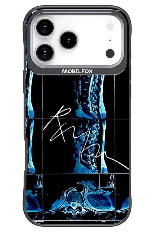 RMN Scolioza 2.0 - Apple iPhone 17 Pro Max