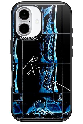 RMN Scolioza 2.0 - Apple iPhone 16
