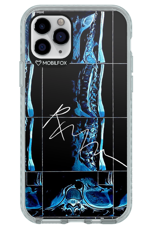 RMN Scolioza 2.0 - Apple iPhone 11 Pro