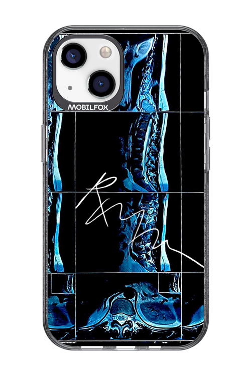 RMN Scolioza 2.0 - Apple iPhone 13