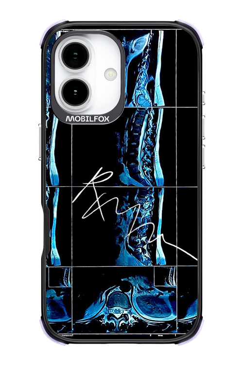 RMN Scolioza 2.0 - Apple iPhone 17