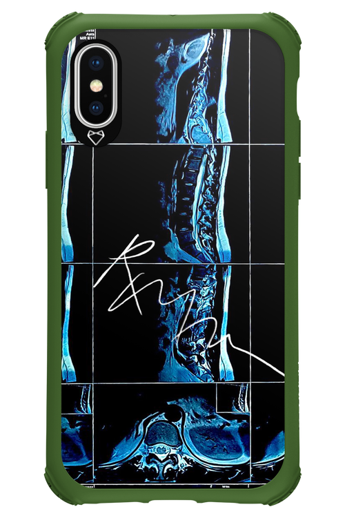 RMN Scolioza 2.0 - Apple iPhone XS
