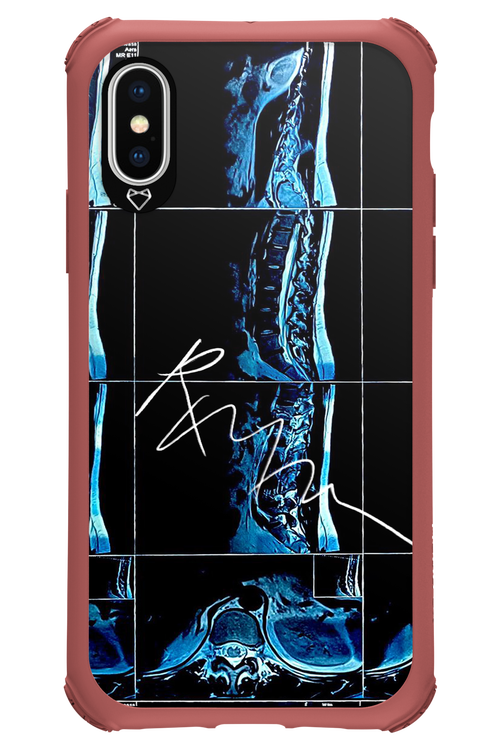 RMN Scolioza 2.0 - Apple iPhone XS