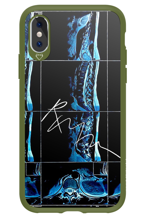 RMN Scolioza 2.0 - Apple iPhone XS