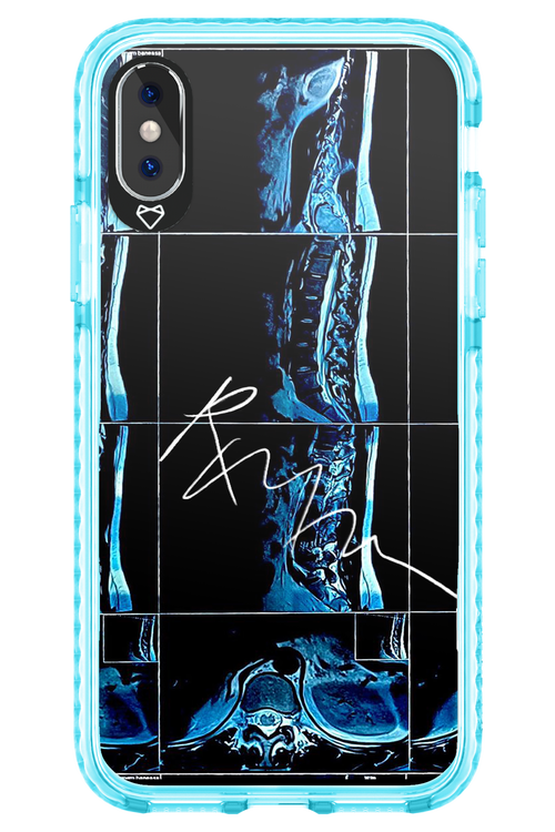 RMN Scolioza 2.0 - Apple iPhone XS
