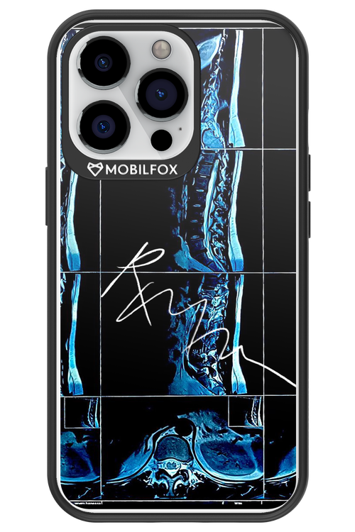 RMN Scolioza 2.0 - Apple iPhone 13 Pro
