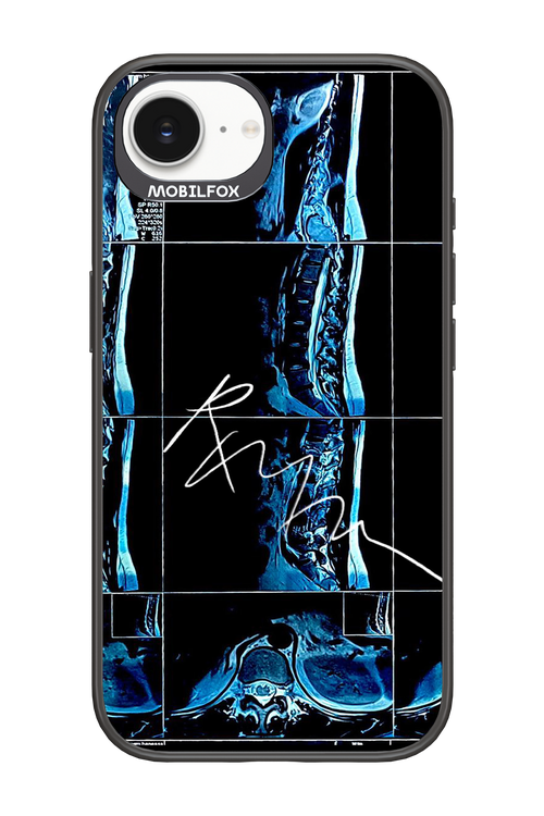 RMN Scolioza 2.0 - Apple iPhone 16e