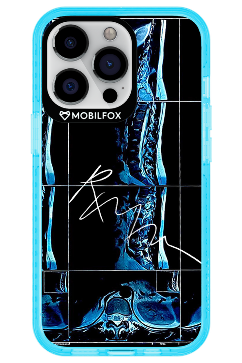 RMN Scolioza 2.0 - Apple iPhone 13 Pro