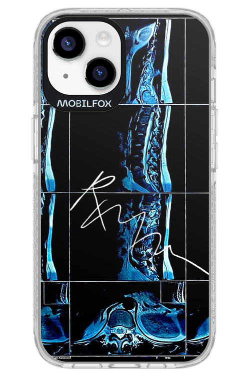 RMN Scolioza 2.0 - Apple iPhone 14