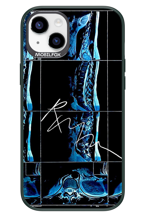 RMN Scolioza 2.0 - Apple iPhone 14 Plus